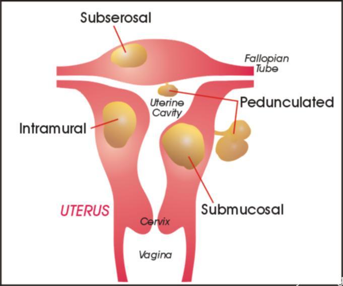 types of fibroid tumors