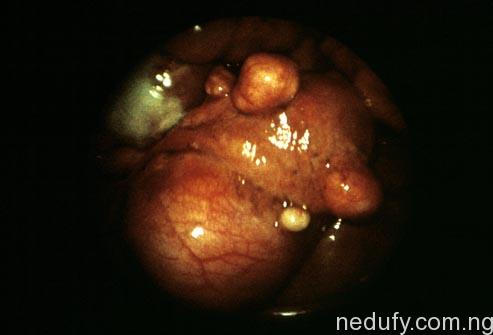 fibroid tumors