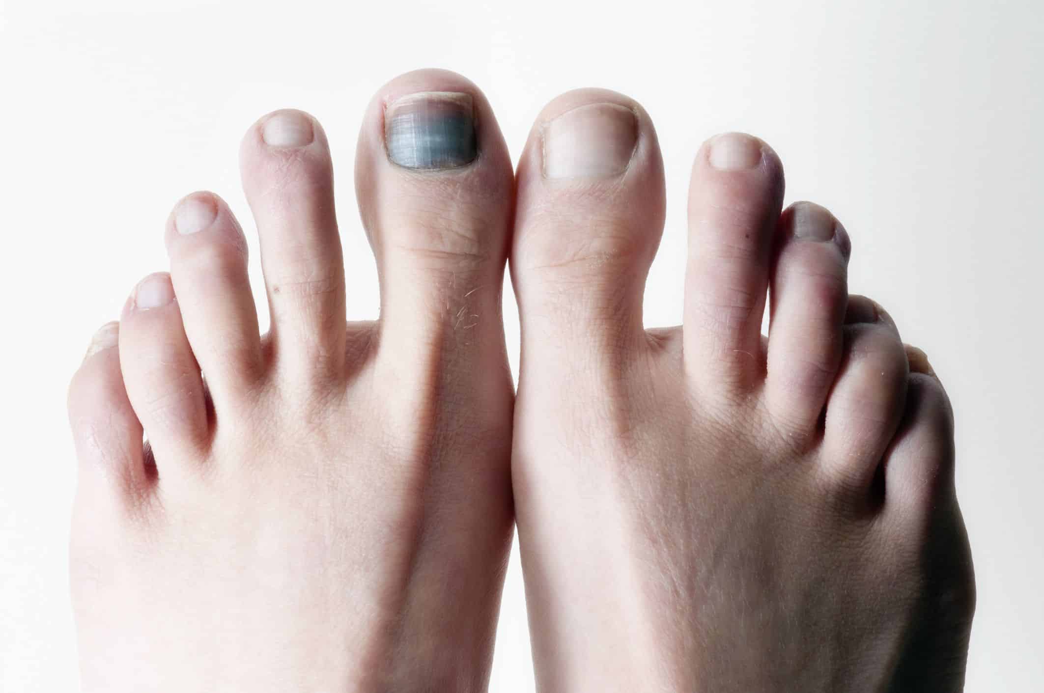 black toenail cancer