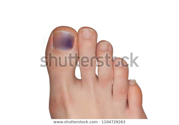 blue toenail fungus