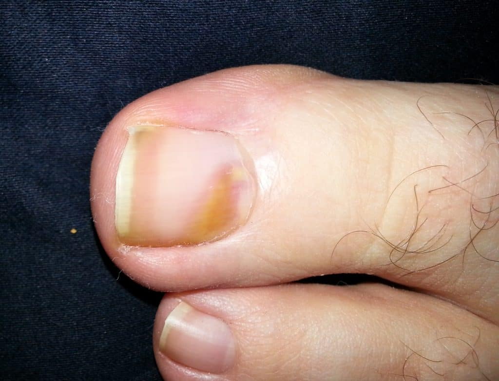 brown toenail cancer and fungus