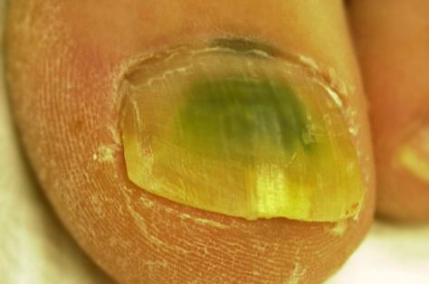 green toenail fungus