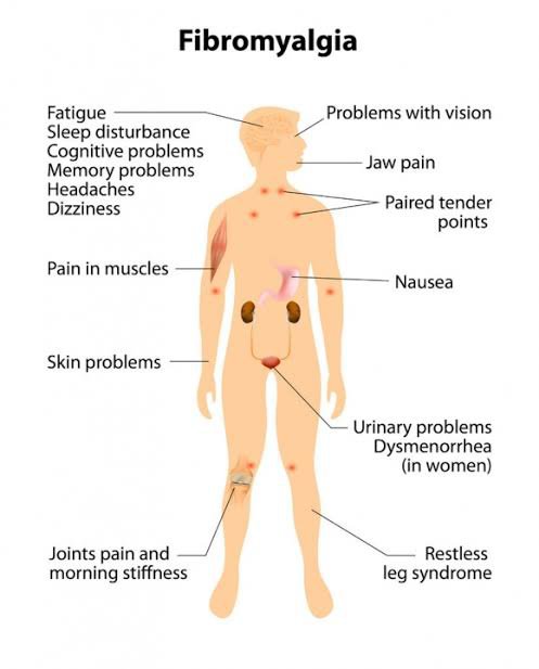 Symptoms experienced by fibromyalgic people