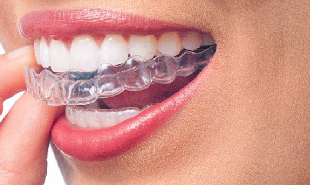 Invisalign dental aligners