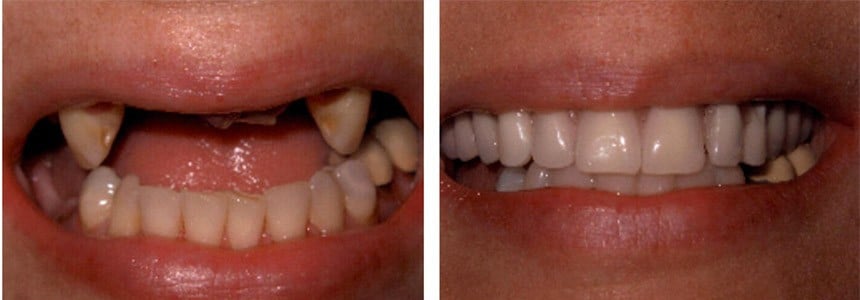Patient's teeth before and after dental implant