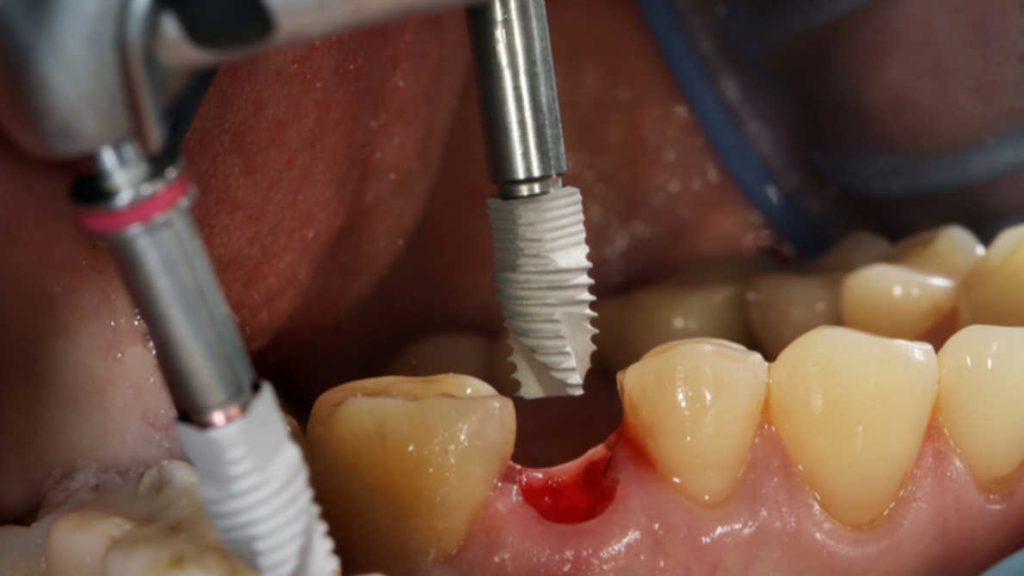 dentist installing dental implants or teeth implants