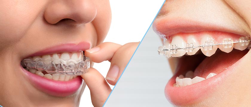invisalign and clear braces