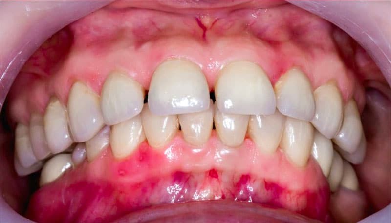 Signs Of Periodontal Disease and periodontitis