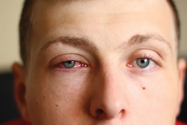 conjunctivitis or pink eye