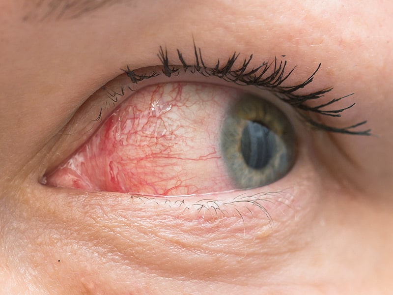 dry eyes is among the common eye diseases