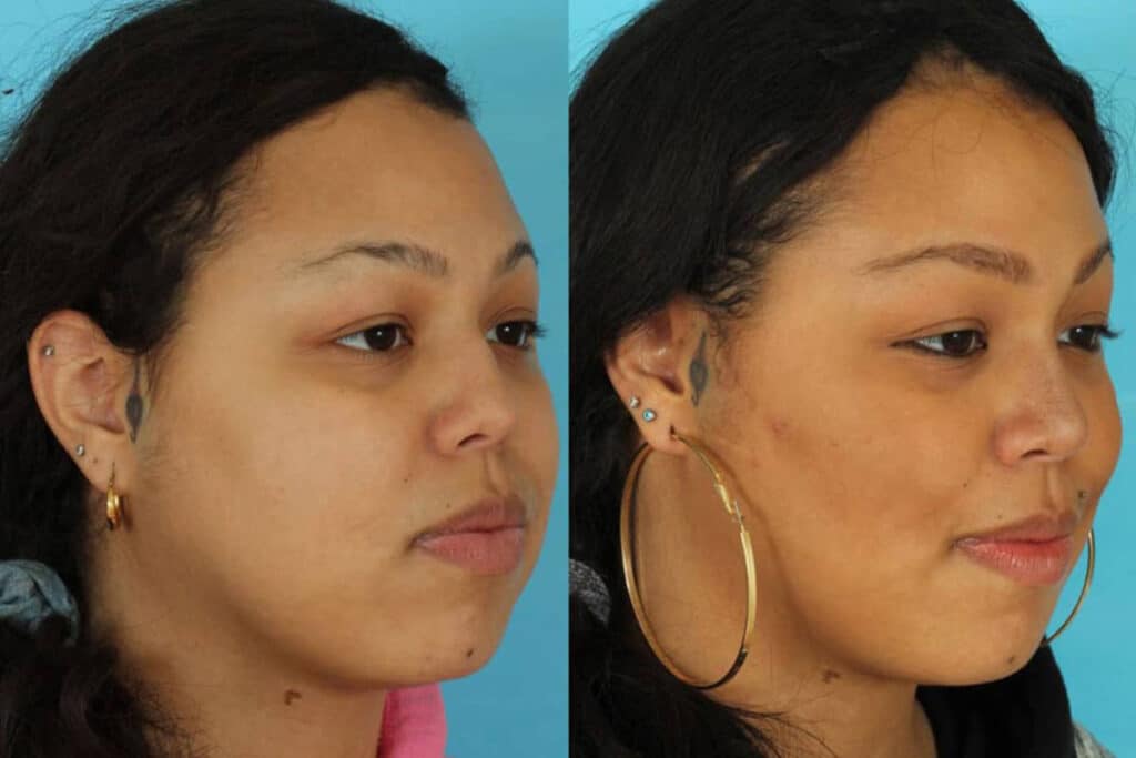 buccal fat reduction surgery before and after 