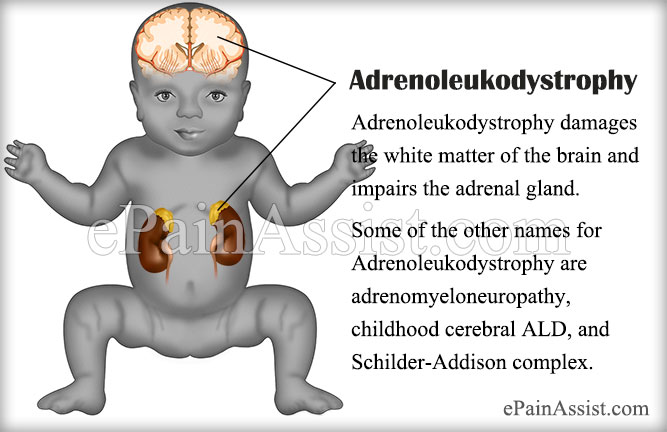 childhood cerebral adrenoleukodystrophy (cald)