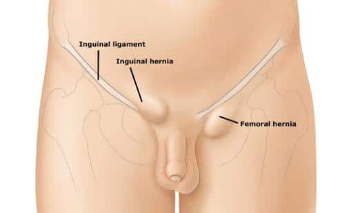 Direct And Indirect Hernia causes, treatment and diagnosis