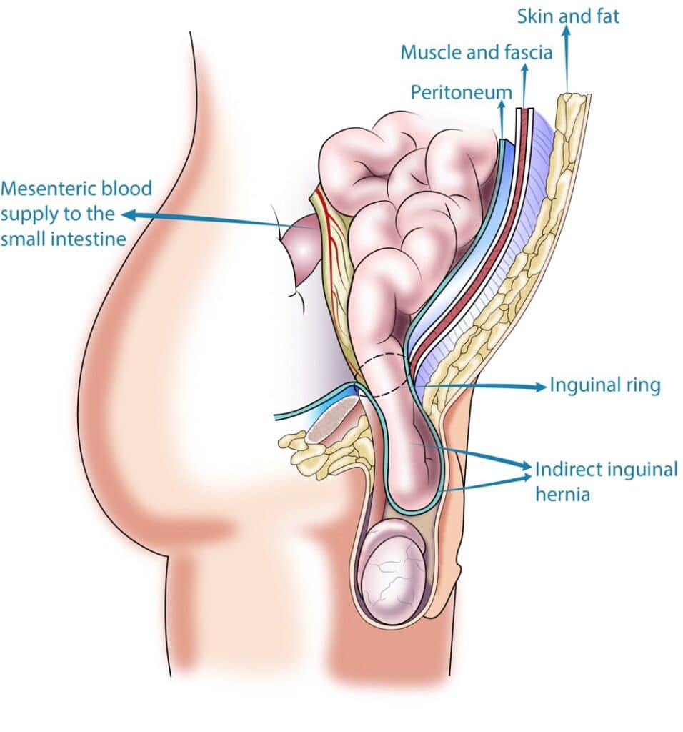 Direct And Indirect Hernia: Causes, Symptoms, Treatment, And Prevention 1