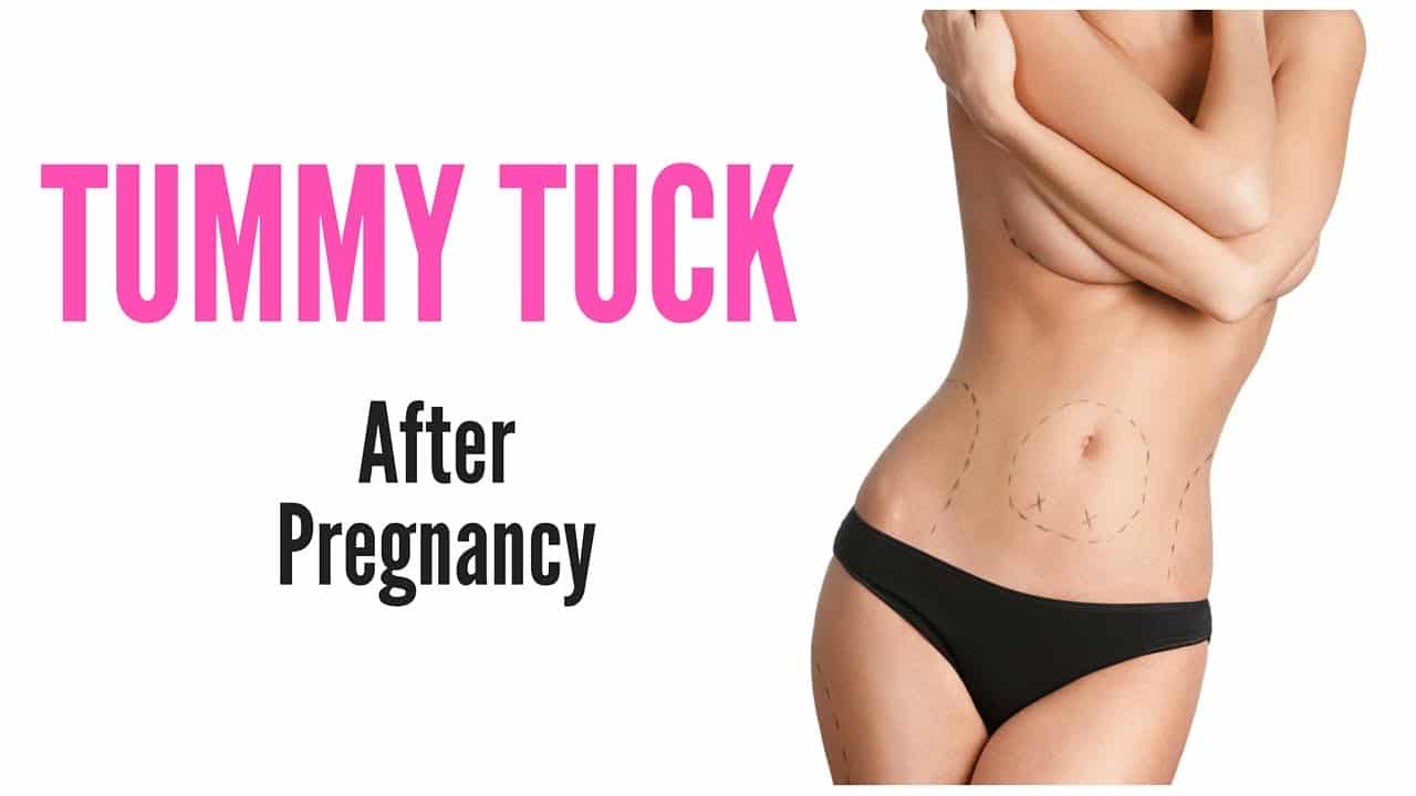 Tummy tuck after pregnancy