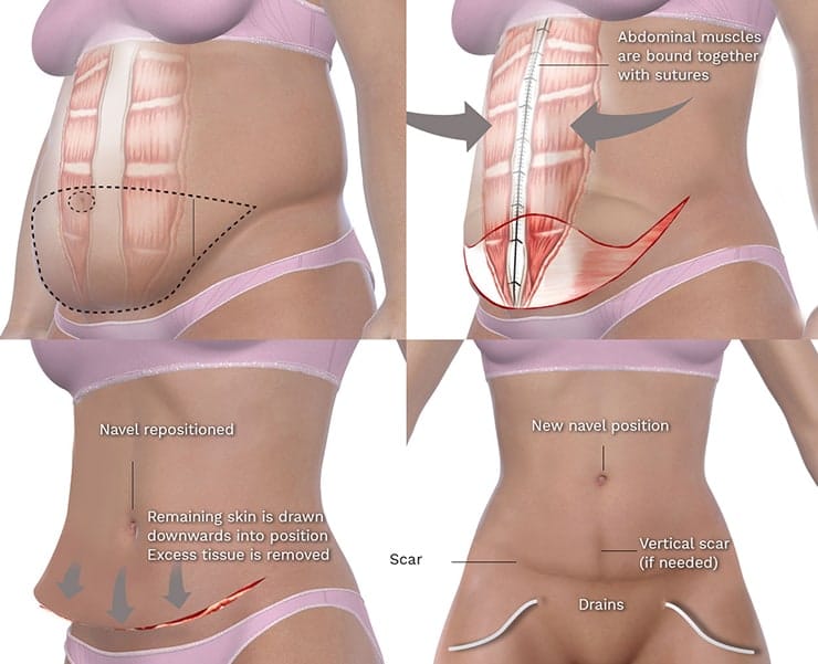 procedures of Tummy tuck after pregnancy