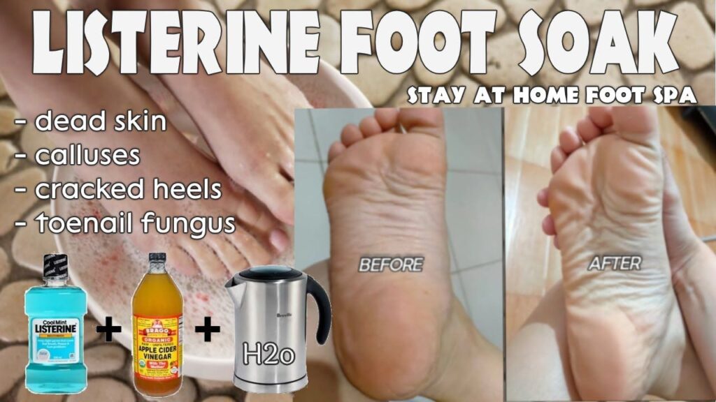 listerine mouthwash for foot soak