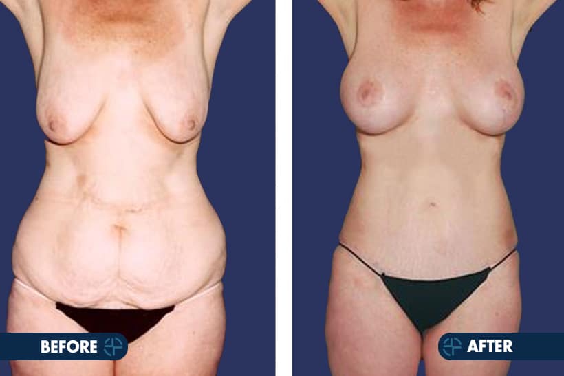 breast lift in breast cosmetic surgery
