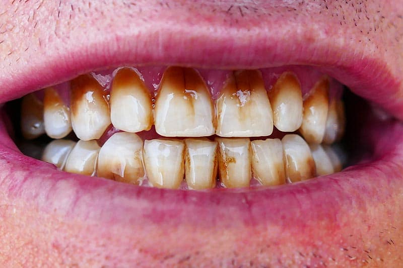 smoking stains and damages the teeth