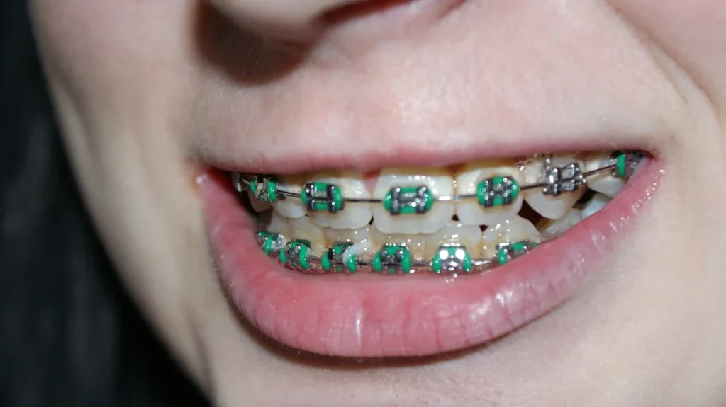A Detailed Note On How Braces Works?