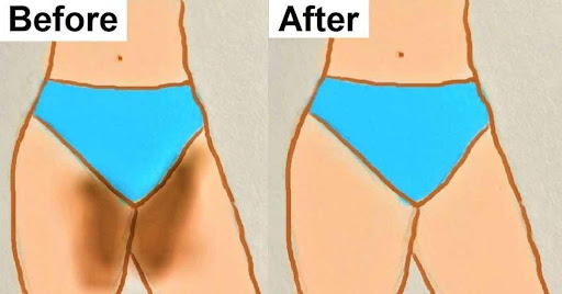 How To Remove Dark Inner Thighs With Colgate And Baking Soda