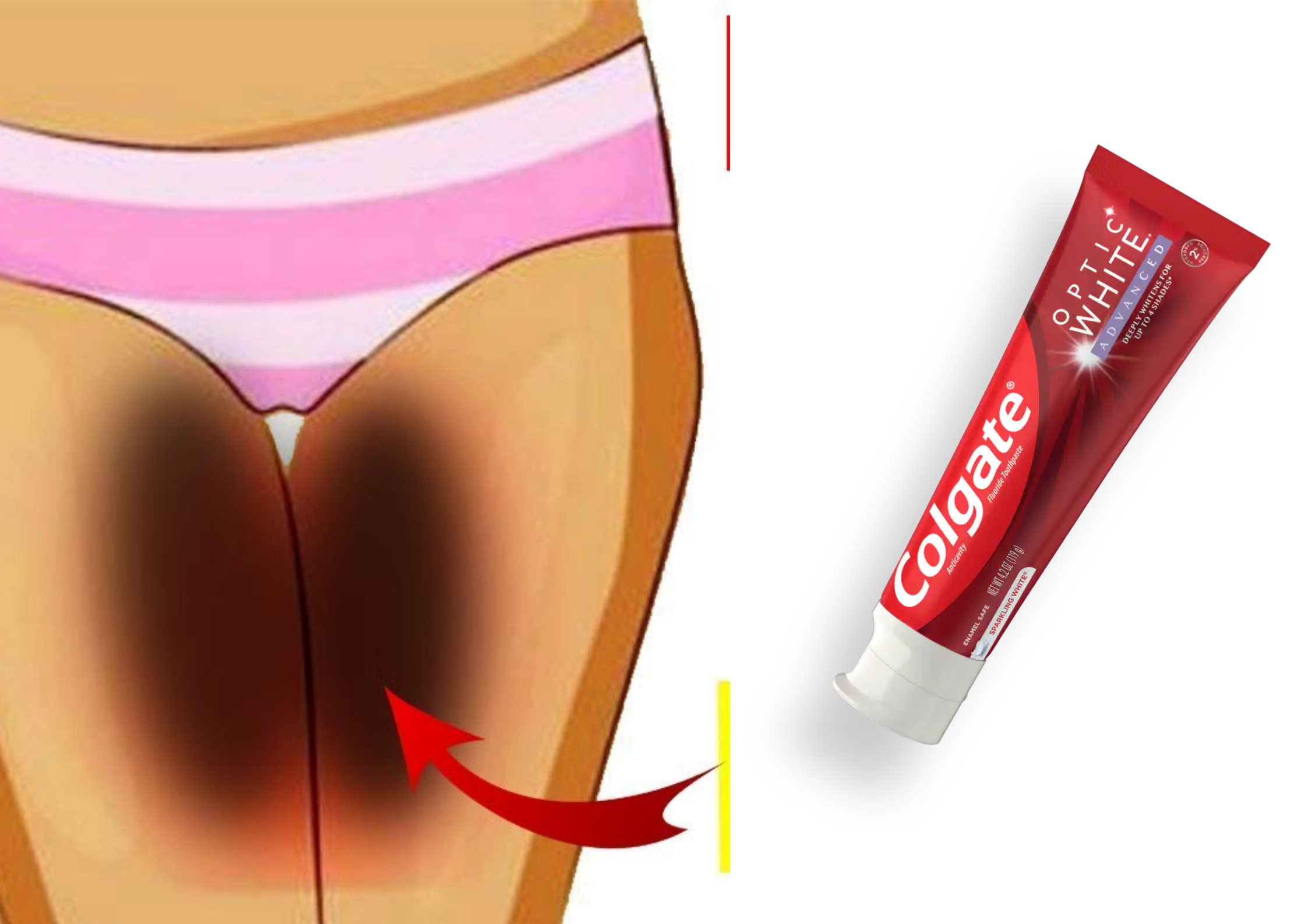How To Remove Dark Inner Thighs With Colgate