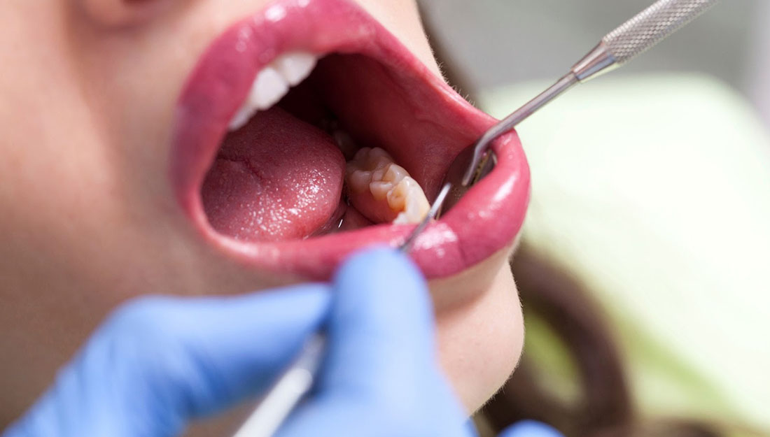 Can I Have Intercourse After Tooth Extraction?