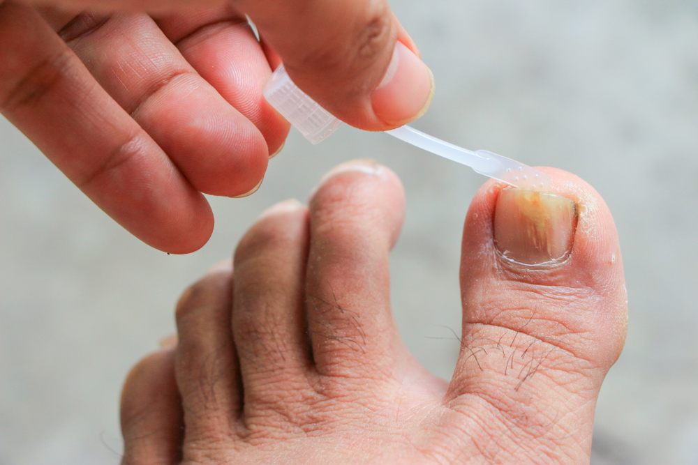 How To Treat Toenail Fungus During Pregnancy