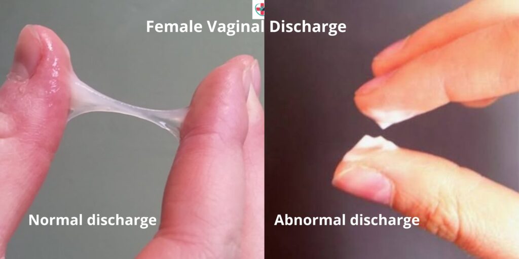Normal and abnormal female discharge