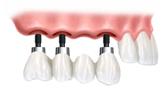 Are Dental Implants a Permanent Solution For Tooth Loss?