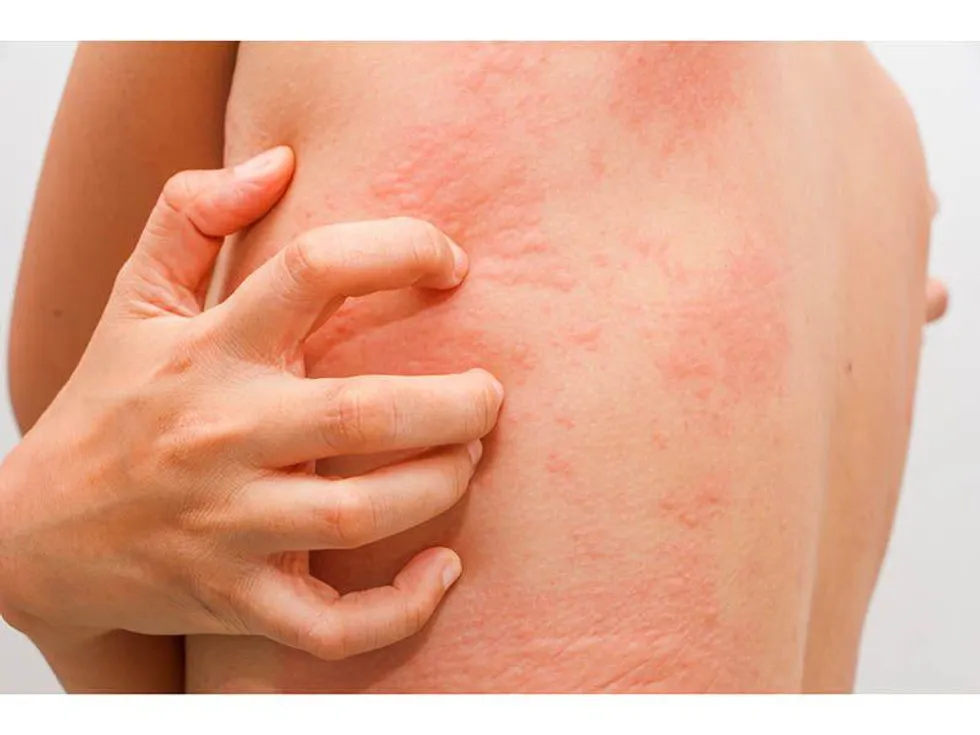 5 Types of Skin Allergies You Should Be Careful About! 1