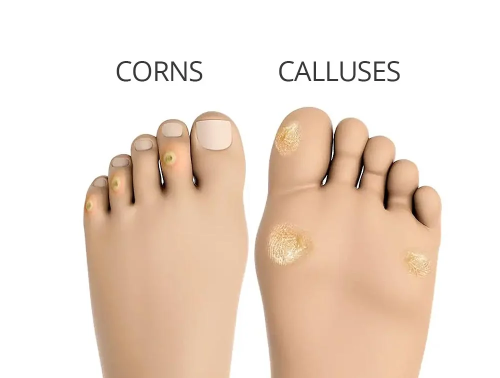 What are calluses and corns?