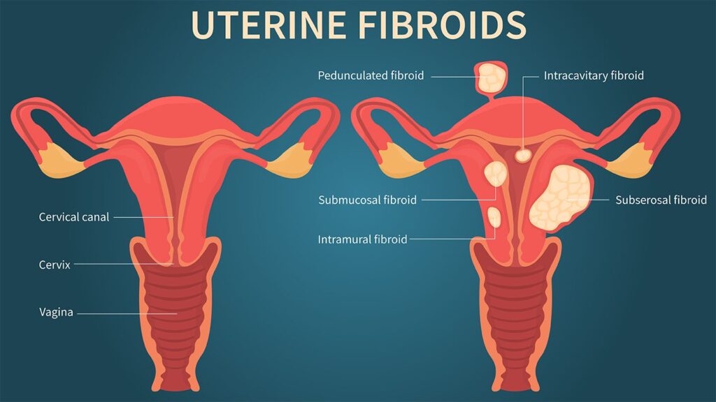 Fibroids are major causes of Menorrhagia
