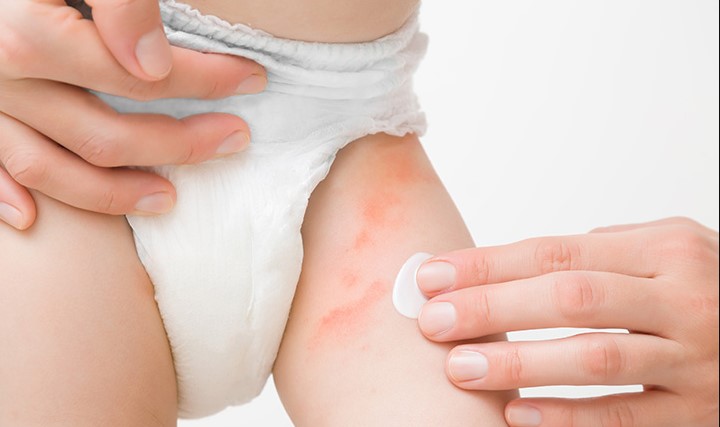 Can You Use Neosporin On Babies Diaper Rash?