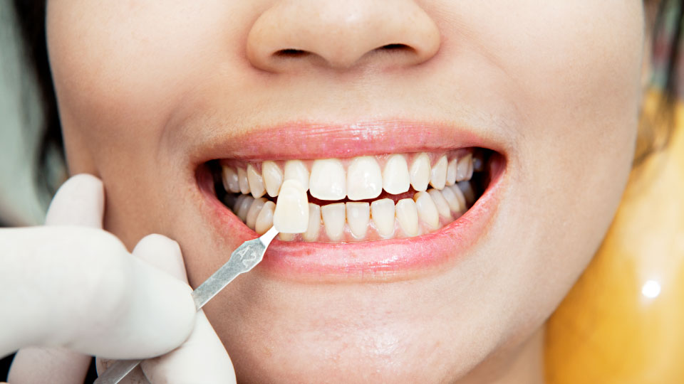 How Long Does It Take To Get Dental Veneers?