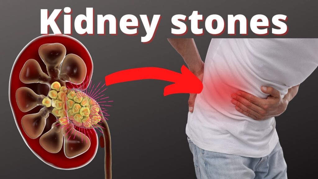 What Causes The Formation Of Kidney Stones?