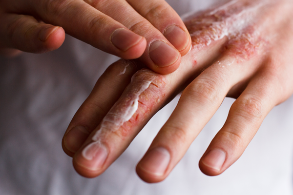 Why Does Hand Sanitizer Burn My Skin?
