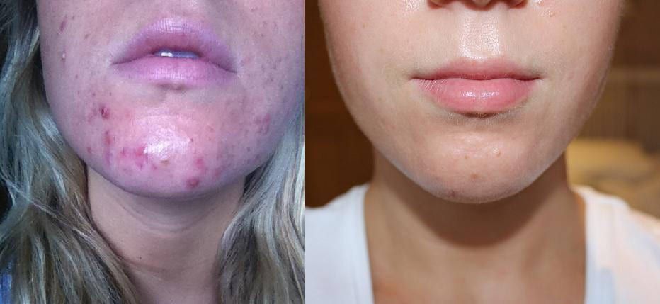 Does Dawn Dish Soap Help With Acne?