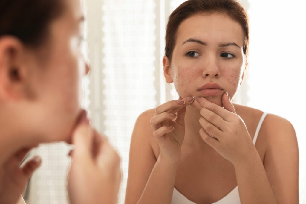 popping your acne can make it worse