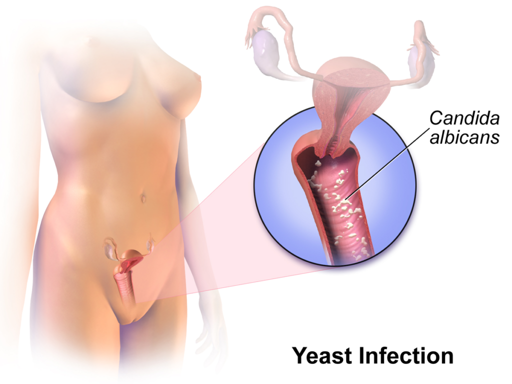 Can Flagyl Treat Yeast Infections?
