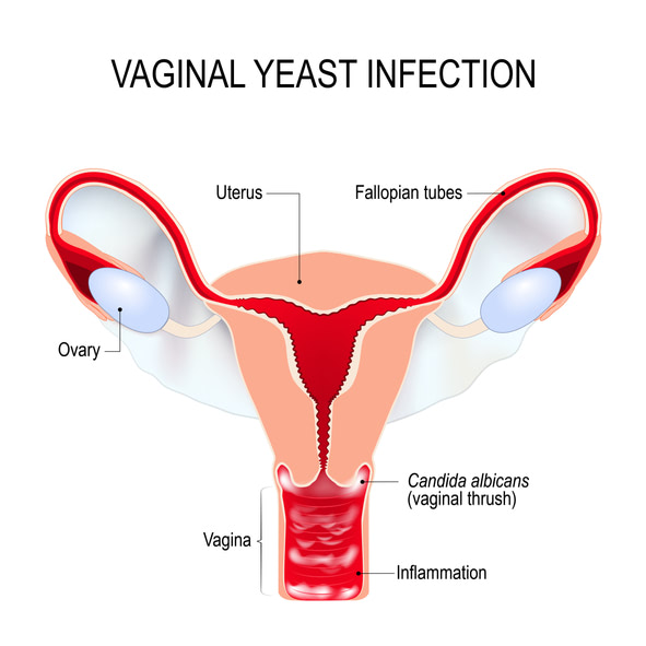 Relationship Between Yeast Infections and STD