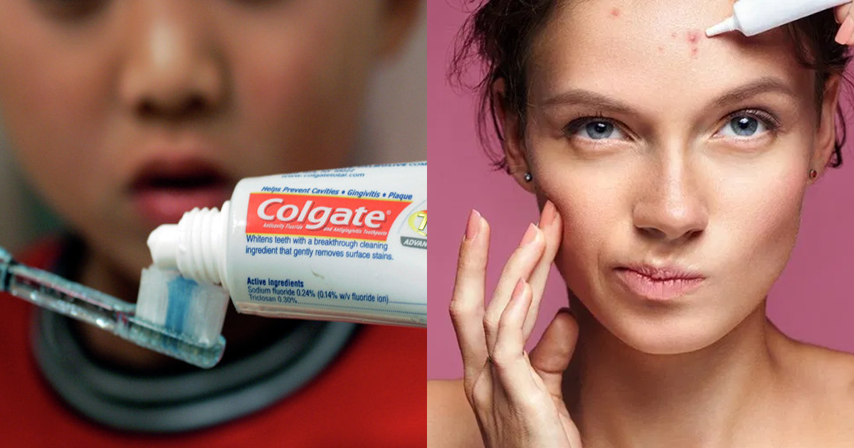 How To Remove Spots From Face In 2 Days Naturally With Colgate