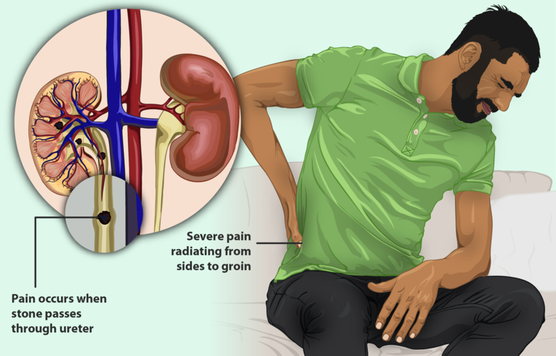 Man suffering Kidney Stones