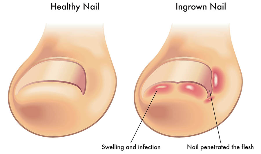 Toenail Growing Under Toenail or ingrown nail