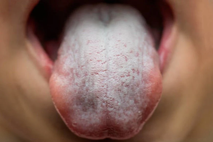 Oral thrush caused by Yeast Infections